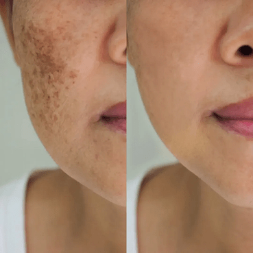 Before After 1