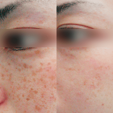 Before After 2