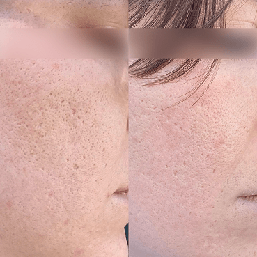 Before After 3