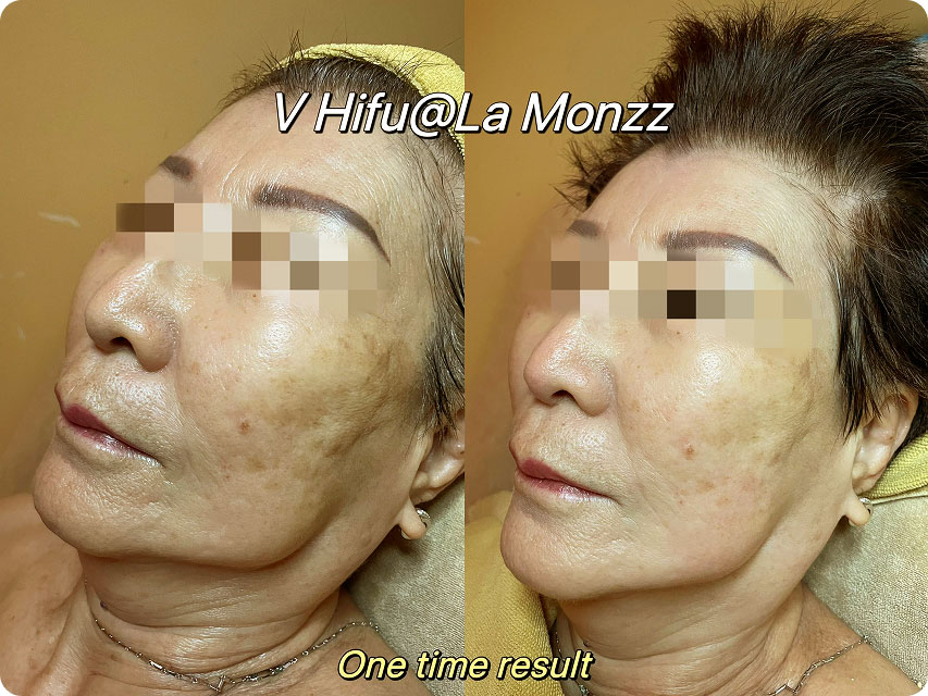 beauty-clinic-facial-treatment-session-kl-malaysia