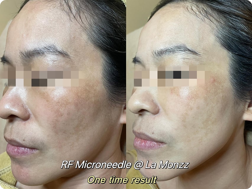 rf-microneedle-facial-treatment-beauty-clinic-kepong-kl-malaysia