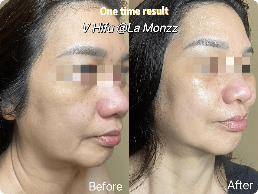 v-hifu-treatment-before-after-face-lifting-kl-malaysia