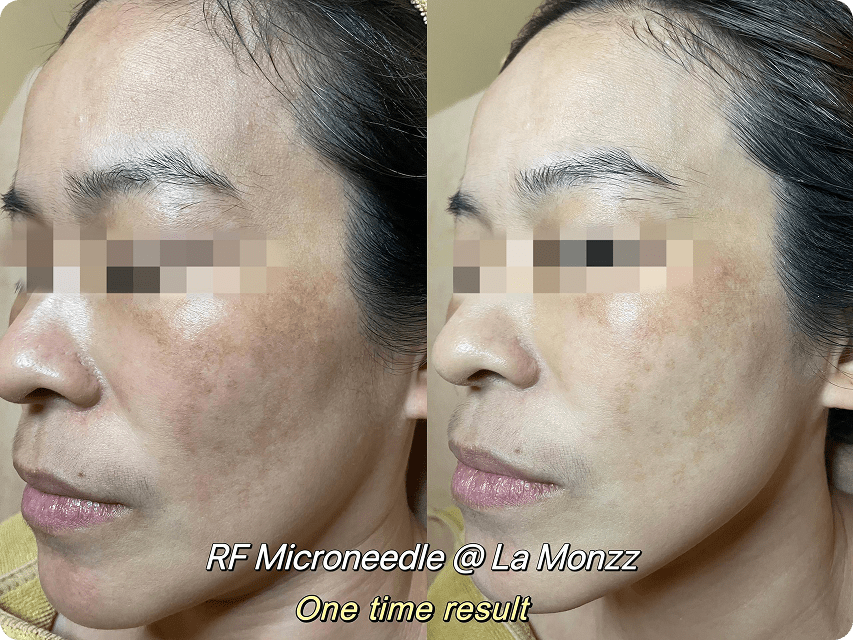 zenlift-anti-aging-facial-before-after-beauty-clinic-kl