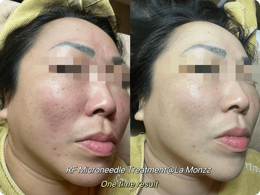 zenlift-facial-treatment-before-after-kepong-malaysia