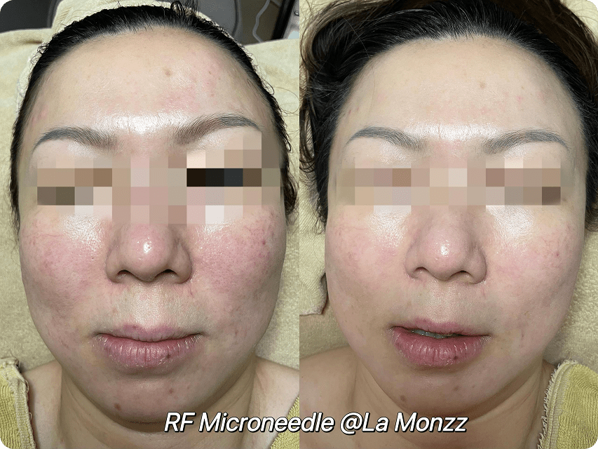 zenlift-micro-therapy-before-after-result-kl-malaysia