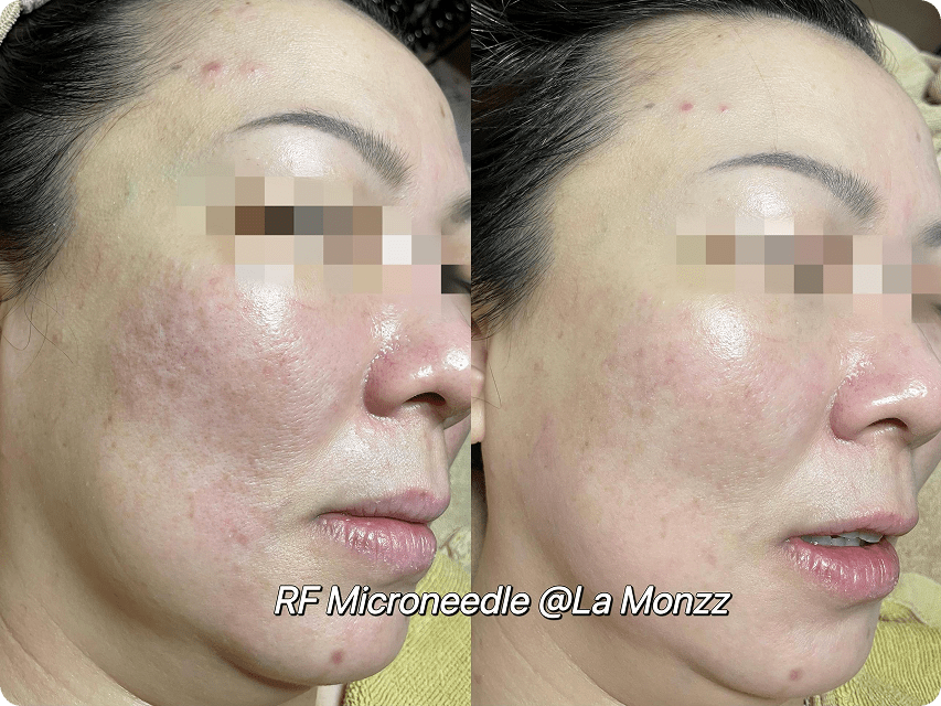 zenlift-micro-therapy-before-after-skin-improvement-kl
